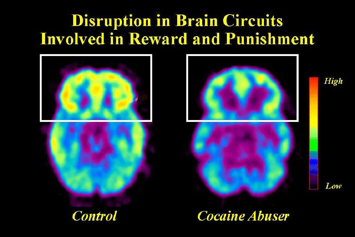 PET scan showing reduced activity in the front area of the brain involved in Reward and Punishment in Cocaine abusers versus control subjects