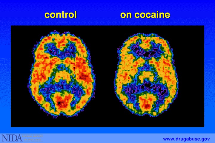 PET scans showing Cocaine user next to control