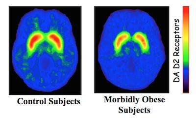 Image of brain scans of control and Obese subjects showing reduced DA D2 receptor activity from control