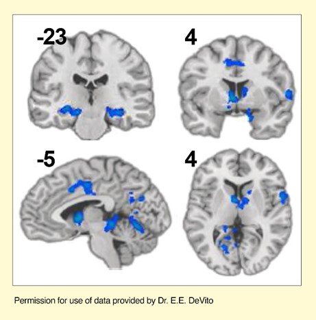 Better neural efficiency in brain activity during a cognitive task (blue) was associated with several evidence-based behavioral treatments.
