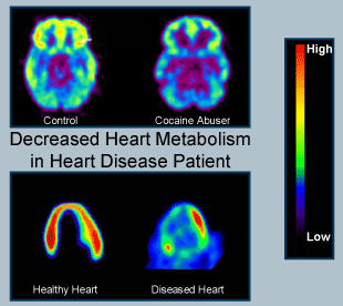 Decreased Brain Metabolism in Drug Abuser figure