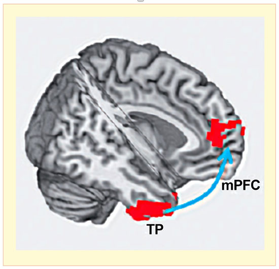 Brain diagram showing connectivity in the brain circuit that joins the temporal pole (TP) and the medial prefrontal cortex (mPFC) predicted relapse to cocaine use.