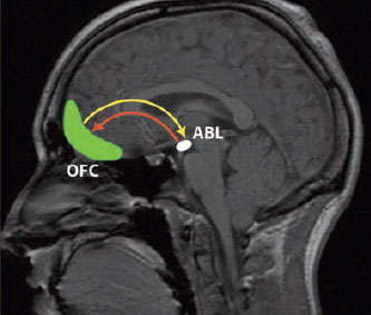 brain MRI illustration showing cocaine weakens signalling betweeen the orbitofrontal cortex and basolateral amygdala