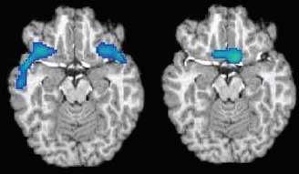 PET scan image showing gender-specific reduction in blood flow in the orbitofrontal cortex with lateral reduction in mailes and more central reduction in females