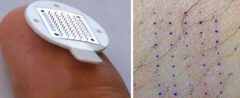 Photo of microarray of needles and epidermal punctures