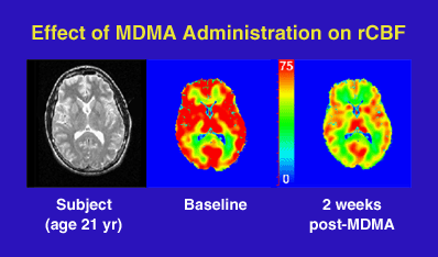 PET scans of brain showing diminished activity in MDMA user