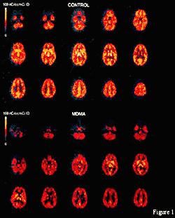 PET scans of normal brain and brain effected by MDMA. Shows much lower serotonin binding in lower brain sections