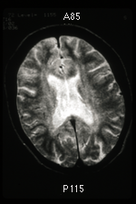 MRI Scan of 25-Year-Old Chronic Solvent Abuser