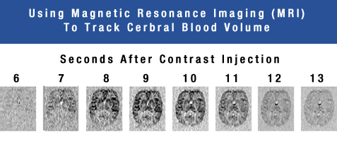 Using Magnetic Resonance Imaging (MRI) To Track Cerebral Blood Volume