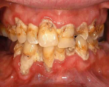 Meth mouth - teeth rotted