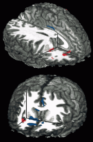 3D brain images - see caption