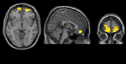 Brain scans showing the left middle frontal gyrus and the left striatum