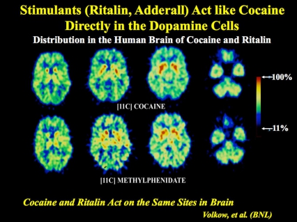 Brain scan images. Stimulants (Ritalin, Adderall) Act like Cocaine Directly in the Dopamine Cells. Distribution in the Human Brain of Cocaine and Ritalin.